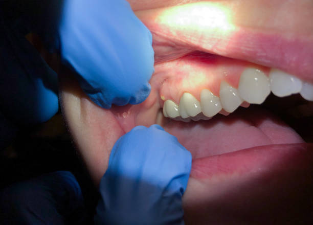 Best Emergency Dentist for Lost Fillings or Crowns in Princevle, IL